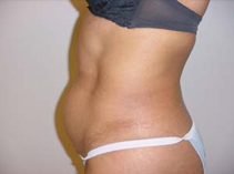 Before Liposuction Abdomen Female torso before liposuction procedure